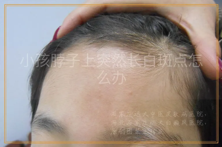 小孩脖子上突然长白斑点怎么办