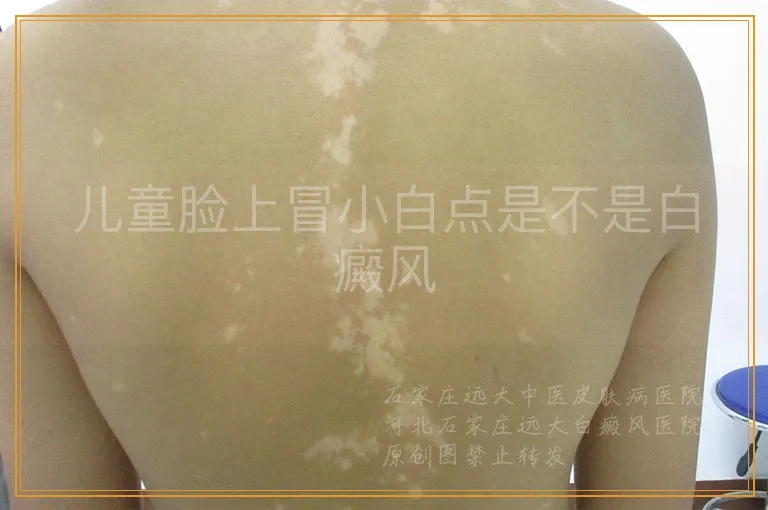 儿童脸上冒小白点是不是白癜风