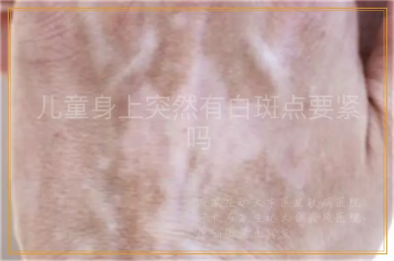 儿童身上突然有白斑点要紧吗