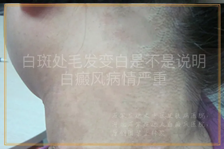 白斑处毛发变白是不是说明白癜风病情严重
