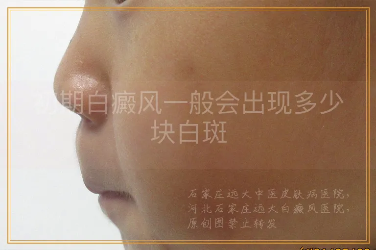 初期白癜风一般会出现多少块白斑
