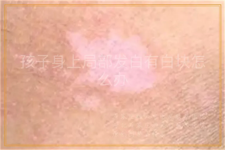 孩子身上局部发白有白块怎么办
