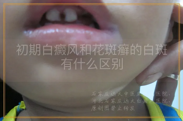 初期白癜风和花斑癣的白斑有什么区别