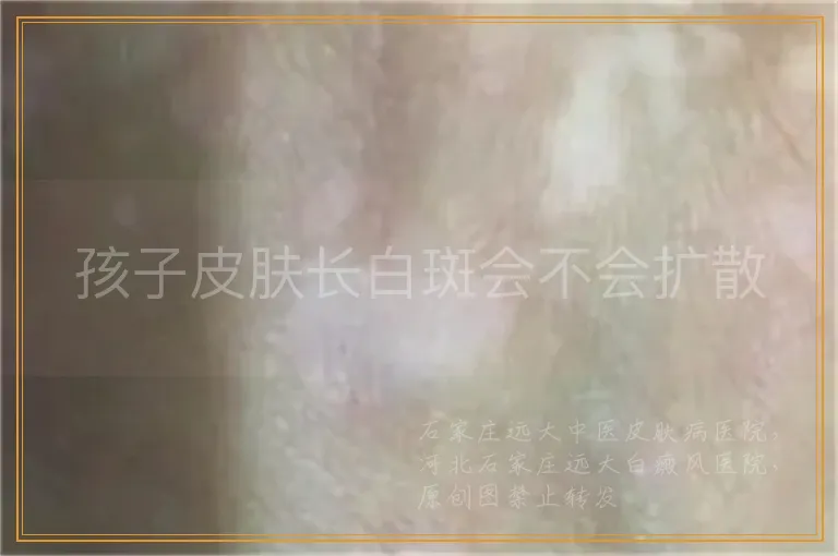 孩子皮肤长白斑会不会扩散