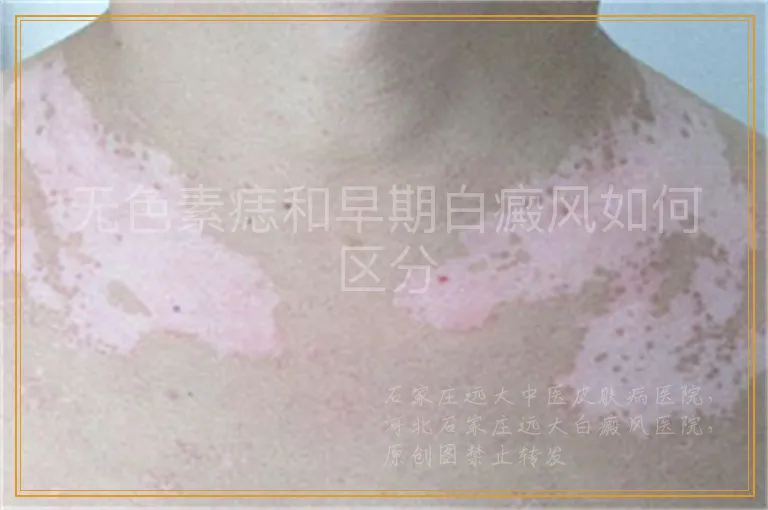 无色素痣和早期白癜风如何区分