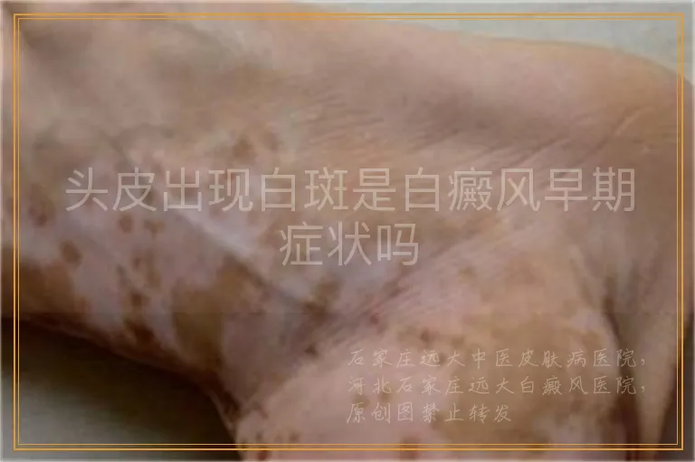 头皮出现白斑是白癜风早期症状吗