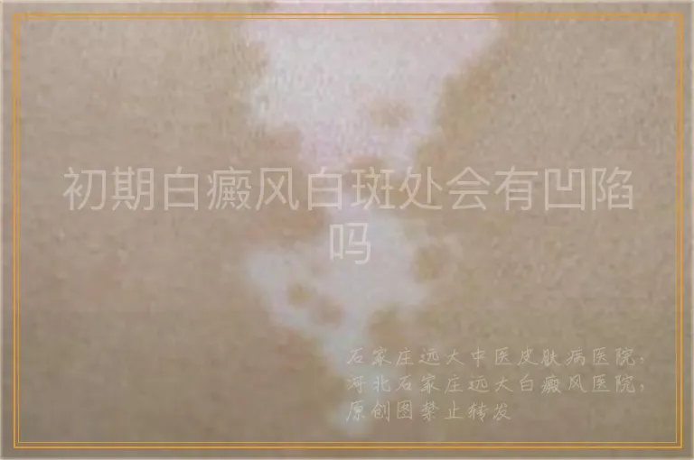 初期白癜风白斑处会有凹陷吗