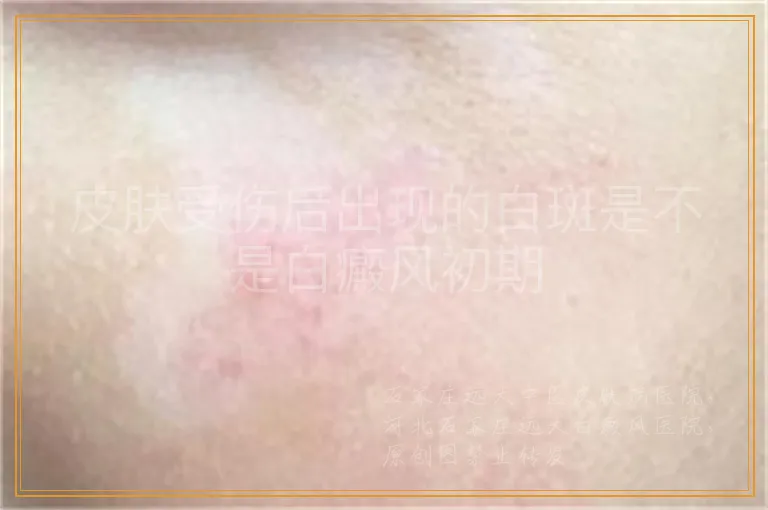 皮肤受伤后出现的白斑是不是白癜风初期