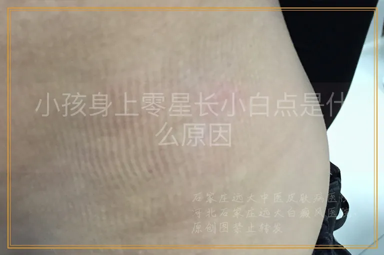 小孩身上零星长小白点是什么原因