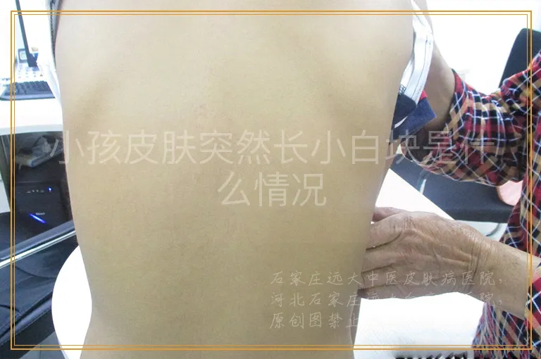 小孩皮肤突然长小白块是什么情况