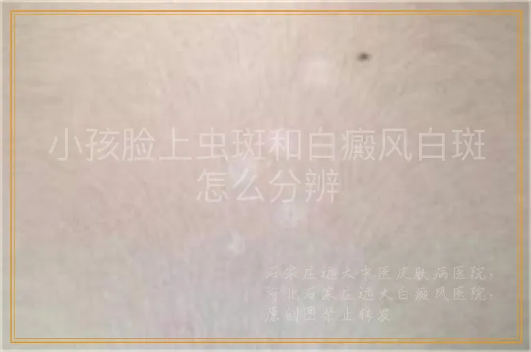 小孩脸上虫斑和白癜风白斑怎么分辨