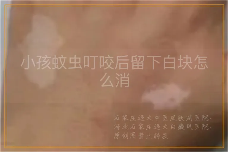 小孩蚊虫叮咬后留下白块怎么消