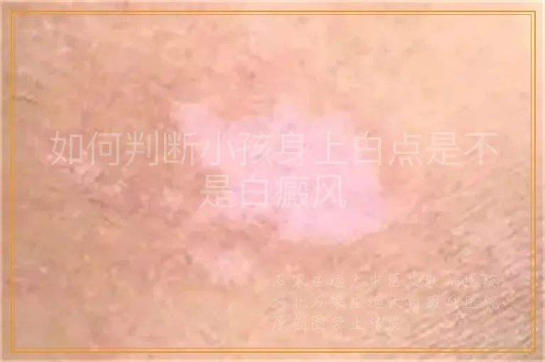 如何判断小孩身上白点是不是白癜风