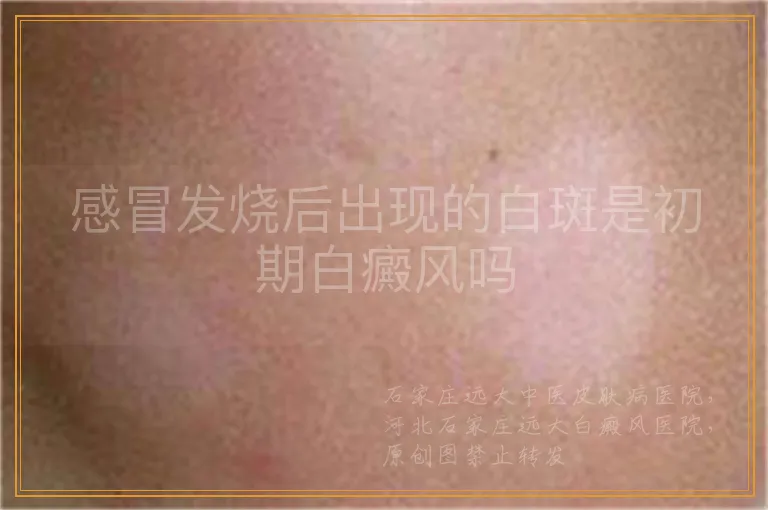 感冒发烧后出现的白斑是初期白癜风吗