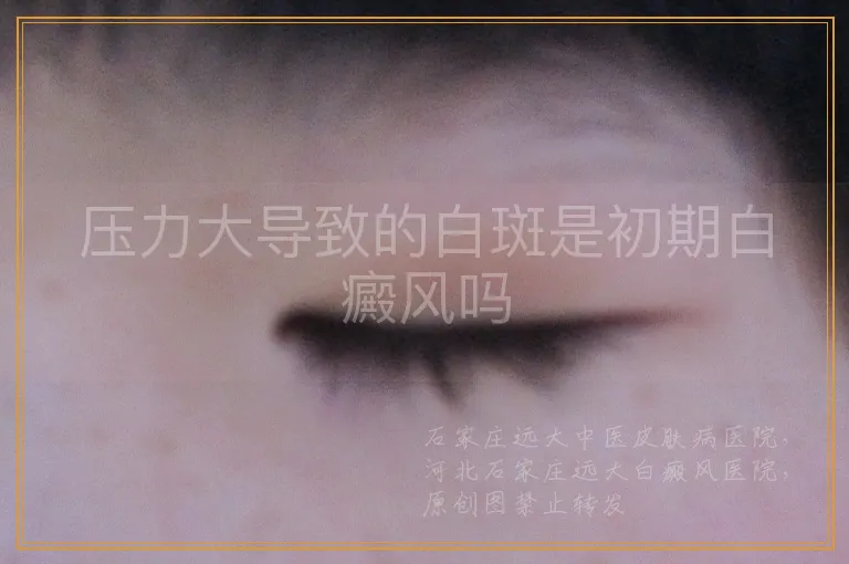 压力大导致的白斑是初期白癜风吗