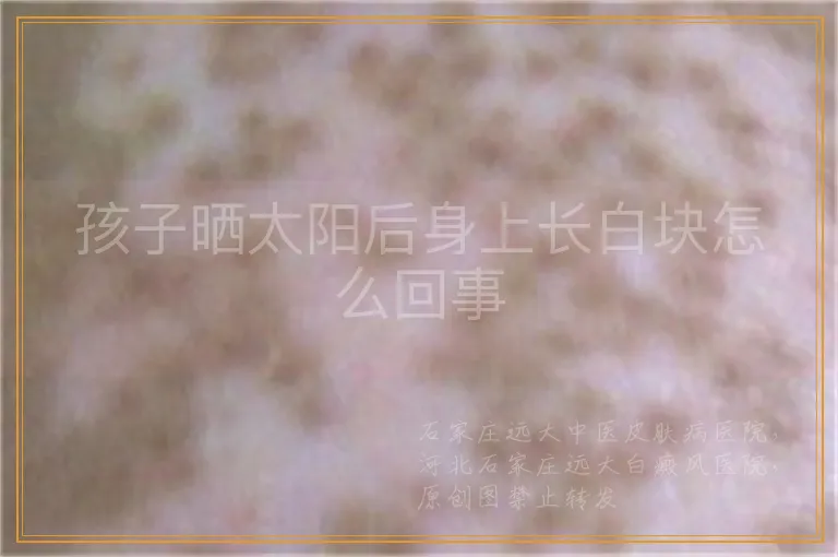 孩子晒太阳后身上长白块怎么回事