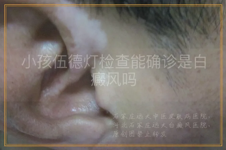 小孩伍德灯检查能确诊是白癜风吗