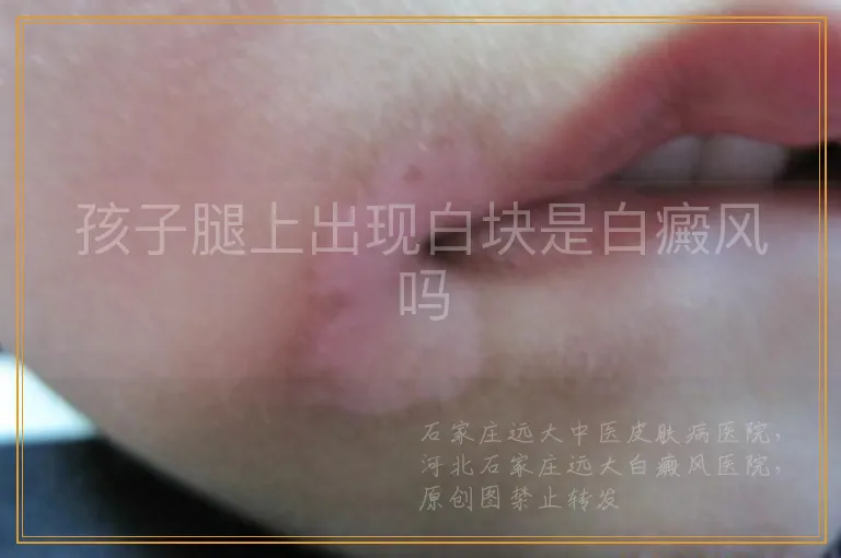 孩子腿上出现白块是白癜风吗