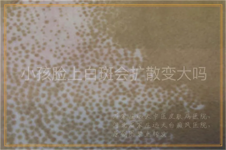 小孩脸上白斑会扩散变大吗