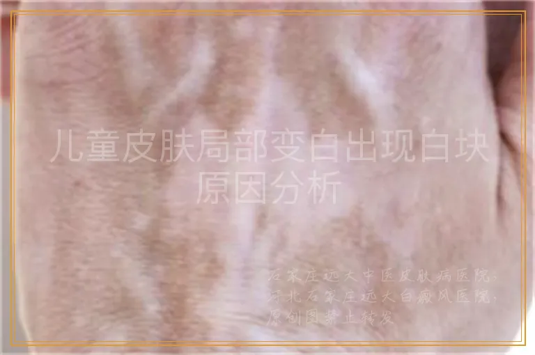 儿童皮肤局部变白出现白块原因分析