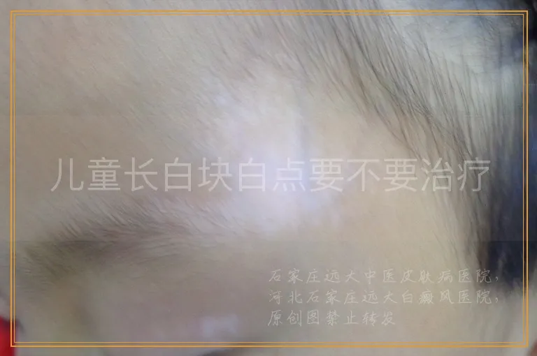 儿童长白块白点要不要治疗
