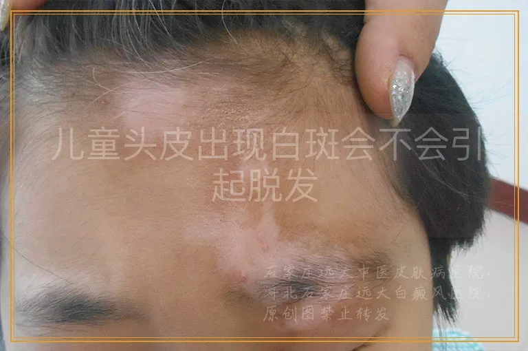 儿童头皮出现白斑会不会引起脱发