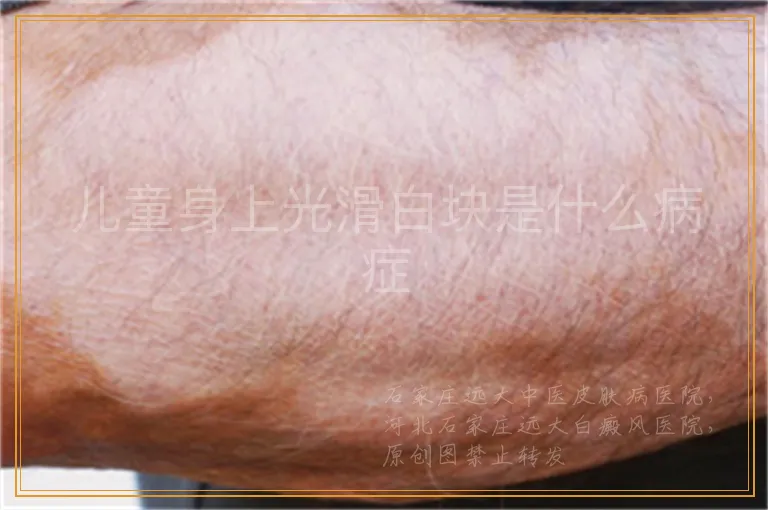 儿童身上光滑白块是什么病症