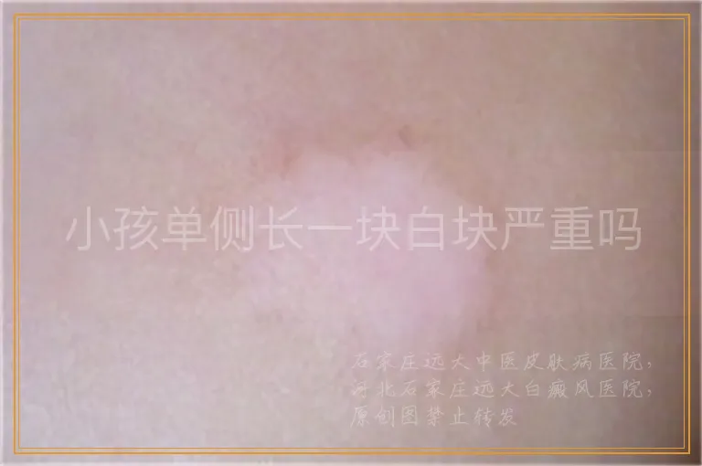 小孩单侧长一块白块严重吗