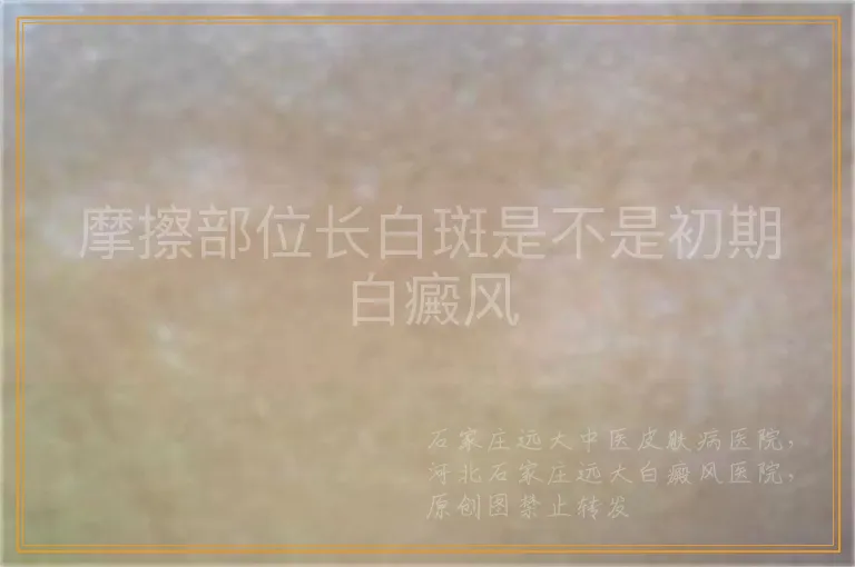 摩擦部位长白斑是不是初期白癜风