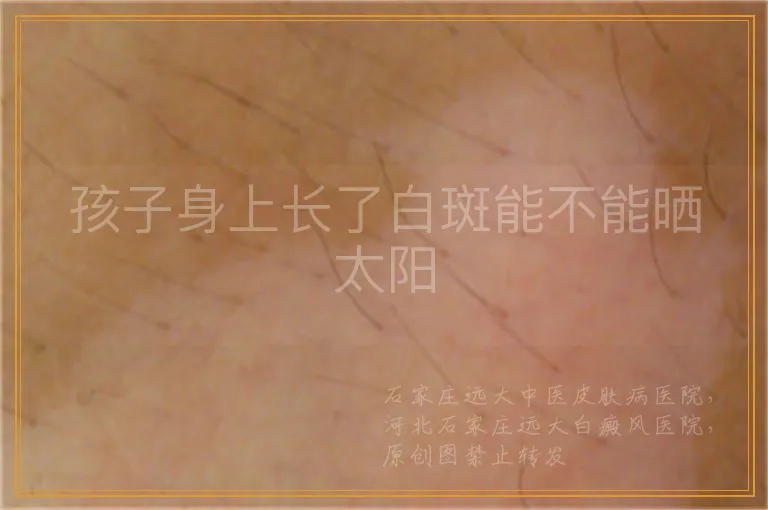 孩子身上长了白斑能不能晒太阳