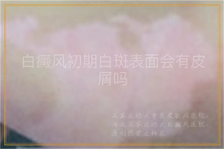 白癜风初期白斑表面会有皮屑吗