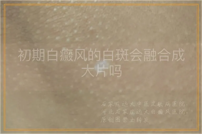 初期白癜风的白斑会融合成大片吗