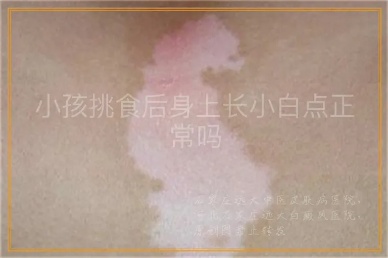 小孩挑食后身上长小白点正常吗