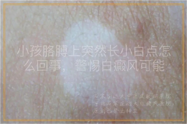 小孩胳膊上突然长小白点怎么回事，警惕白癜风可能