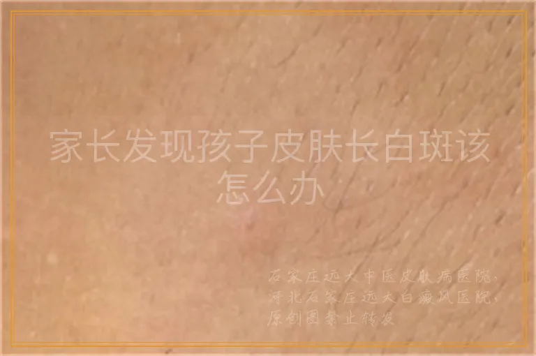 家长发现孩子皮肤长白斑该怎么办