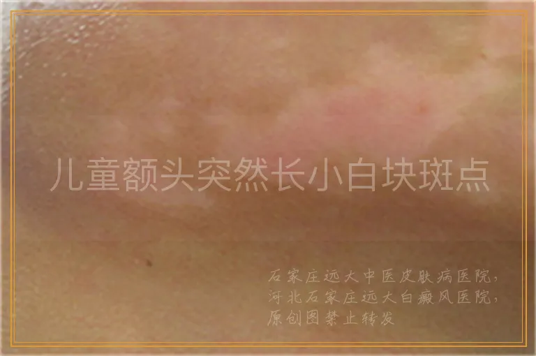 儿童额头突然长小白块斑点