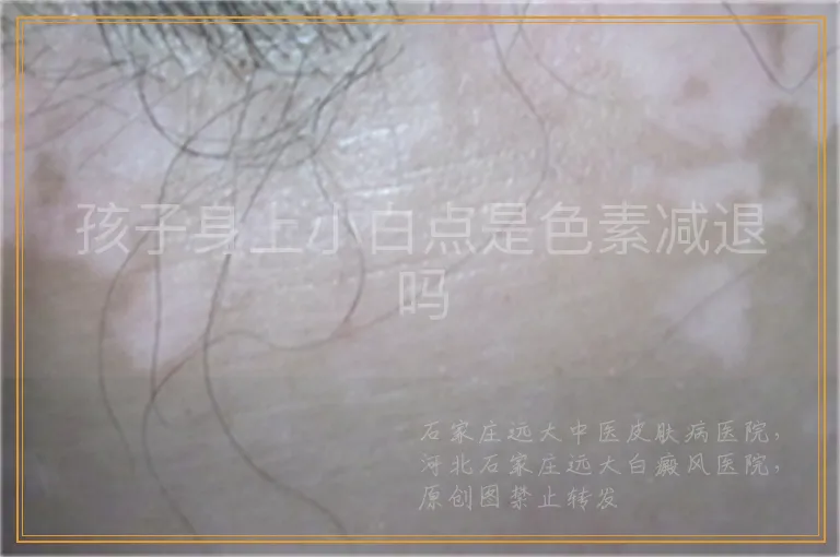 孩子身上小白点是色素减退吗