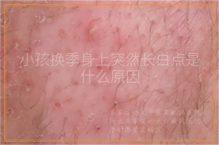 小孩换季身上突然长白点是什么原因