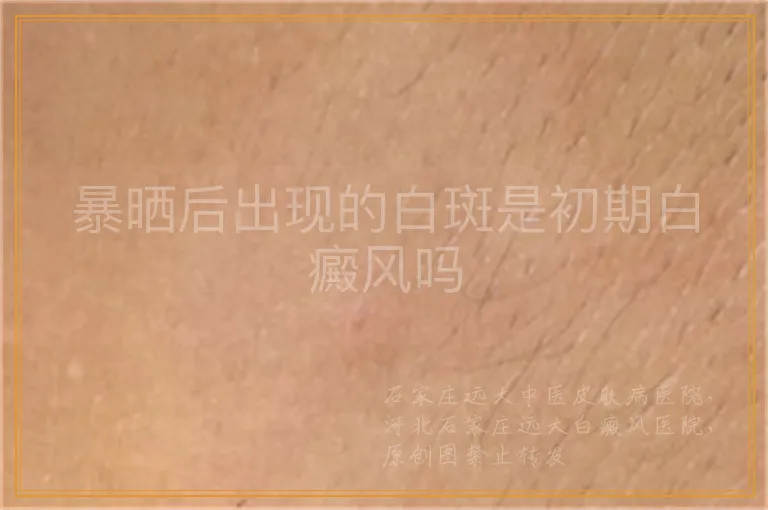 暴晒后出现的白斑是初期白癜风吗