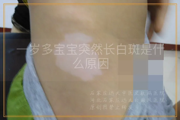 一岁多宝宝突然长白斑是什么原因