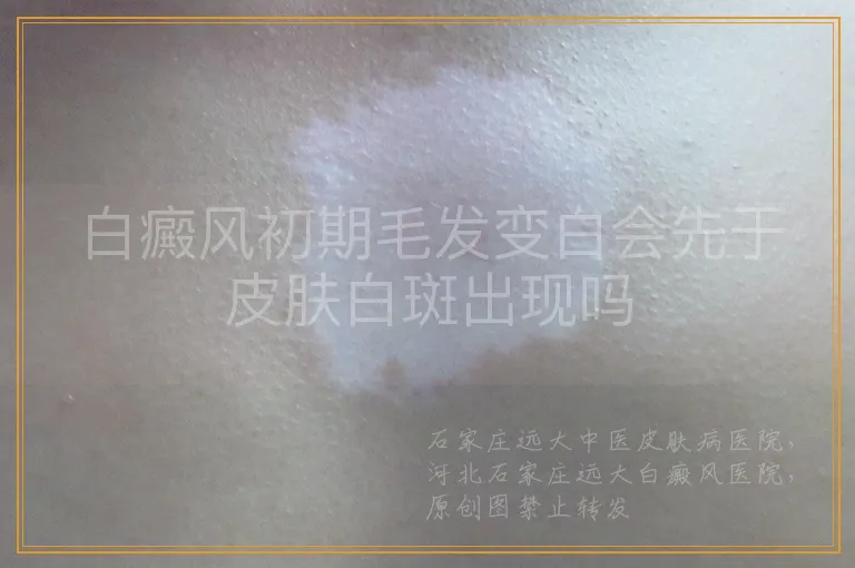 白癜风初期毛发变白会先于皮肤白斑出现吗