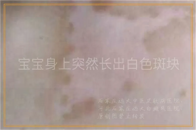 宝宝身上突然长出白色斑块