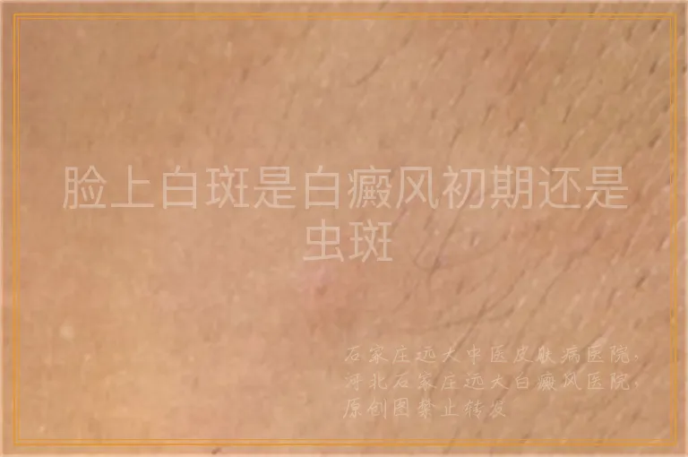 脸上白斑是白癜风初期还是虫斑