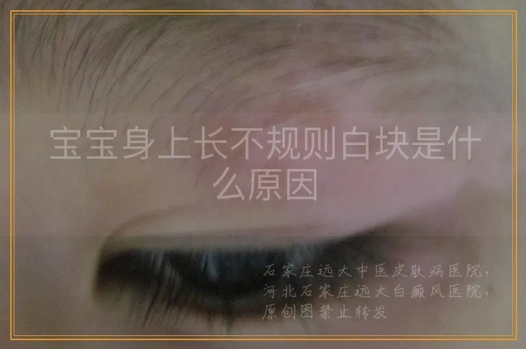 宝宝身上长不规则白块是什么原因