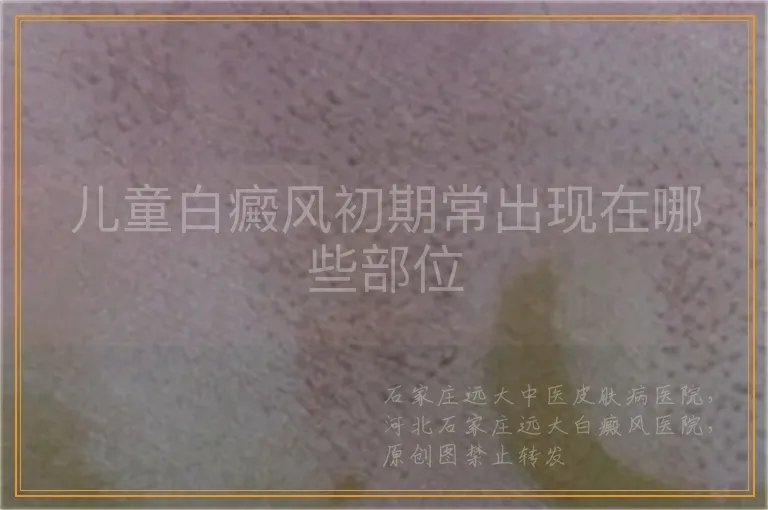 儿童白癜风初期常出现在哪些部位