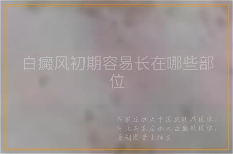 白癜风初期容易长在哪些部位