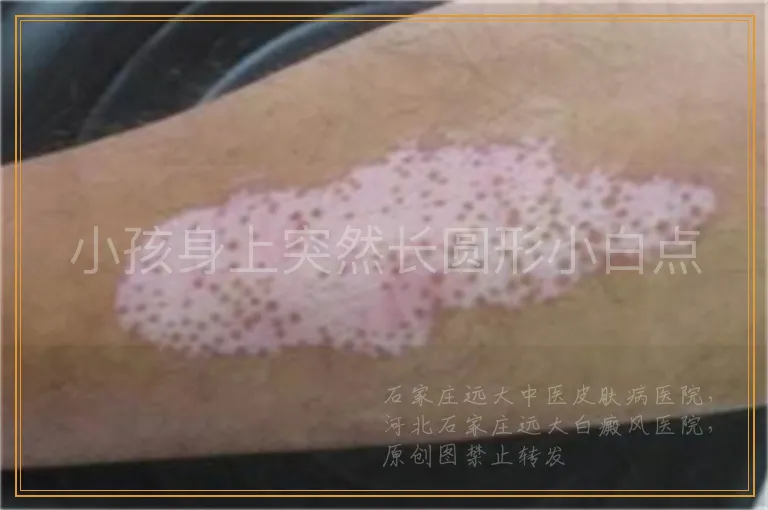 小孩身上突然长圆形小白点