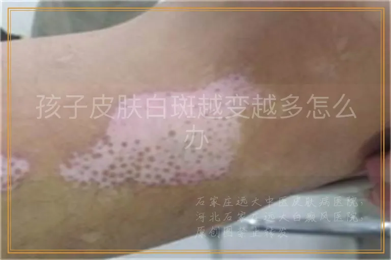 孩子皮肤白斑越变越多怎么办