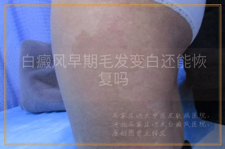 白癜风早期毛发变白还能恢复吗