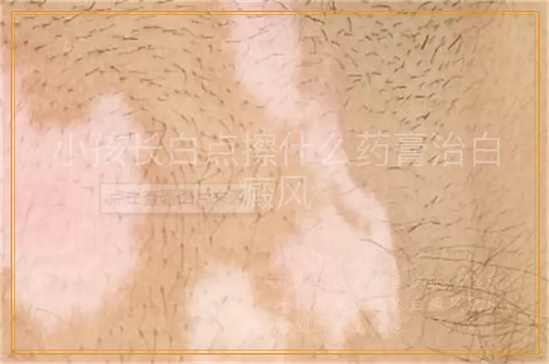 小孩长白点擦什么药膏治白癜风